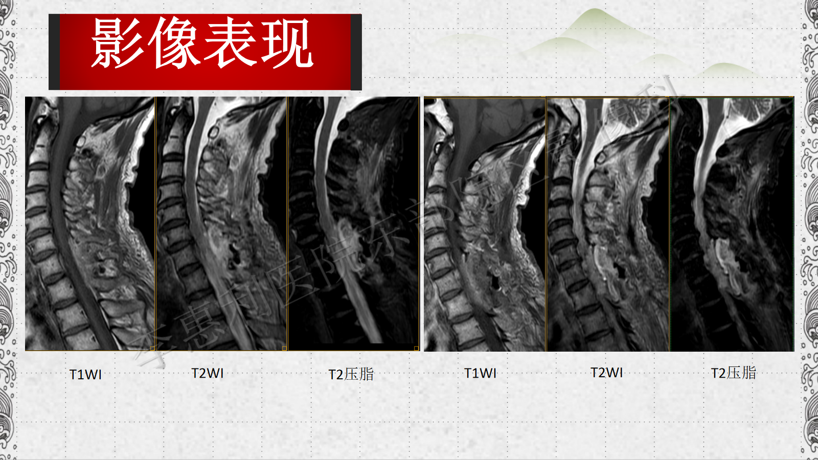 0vf5krt52ll1135.png