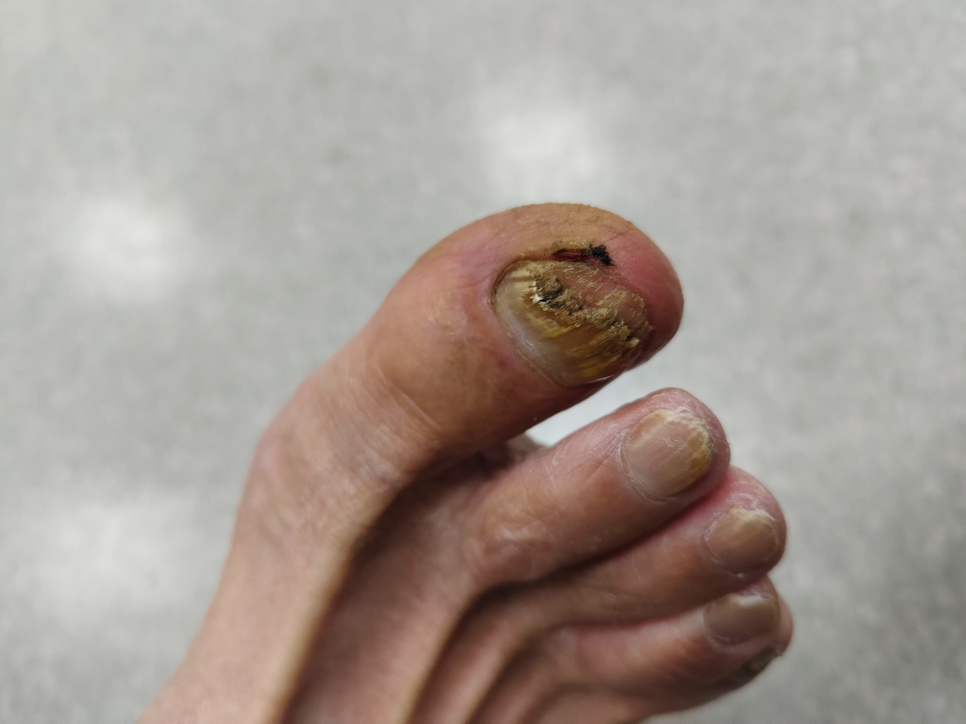 甲沟炎早期处理三个要点