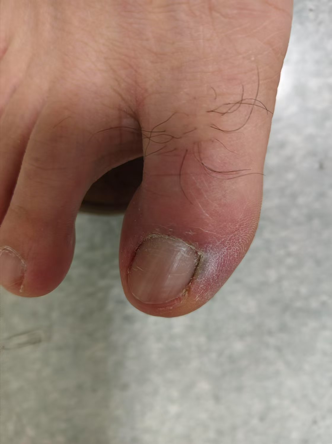 甲沟炎早期处理三个要点